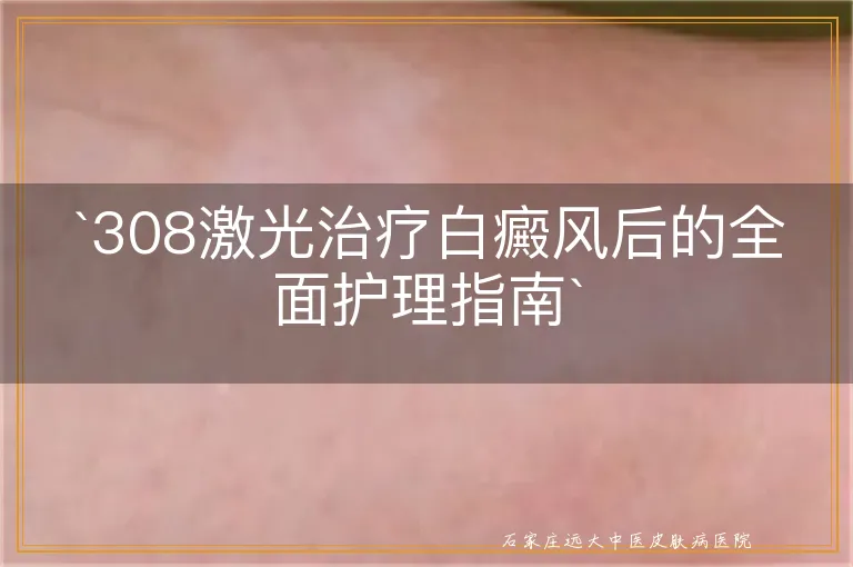 308激光治疗白癜风后的全面护理指南