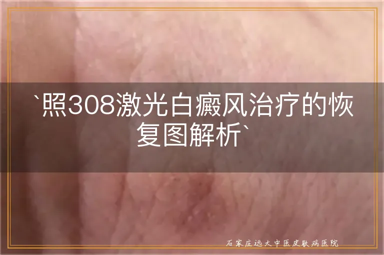 照308激光白癜风治疗的恢复图解析