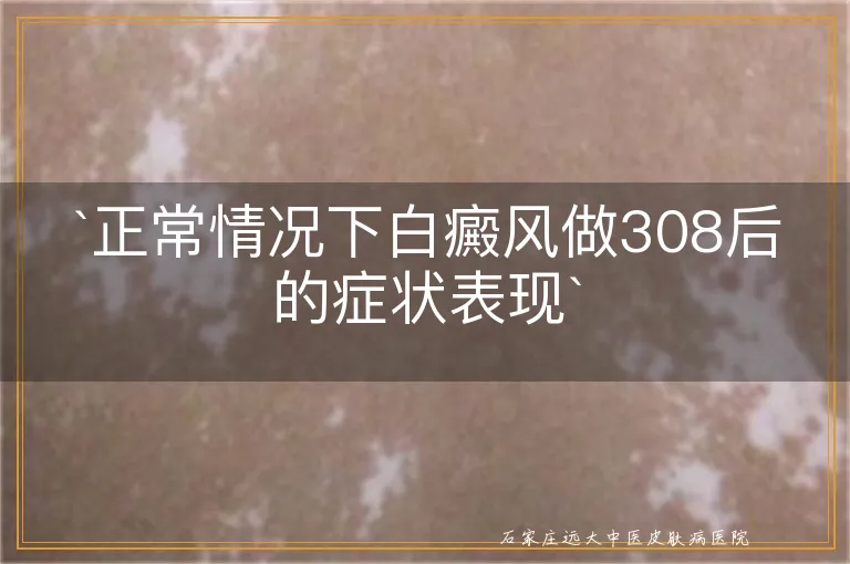 正常情况下白癜风做308后的症状表现