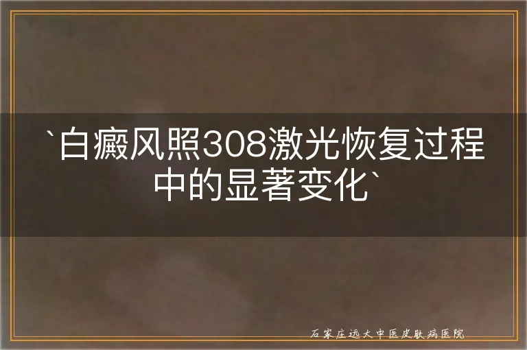 白癜风照308激光恢复过程中的显著变化