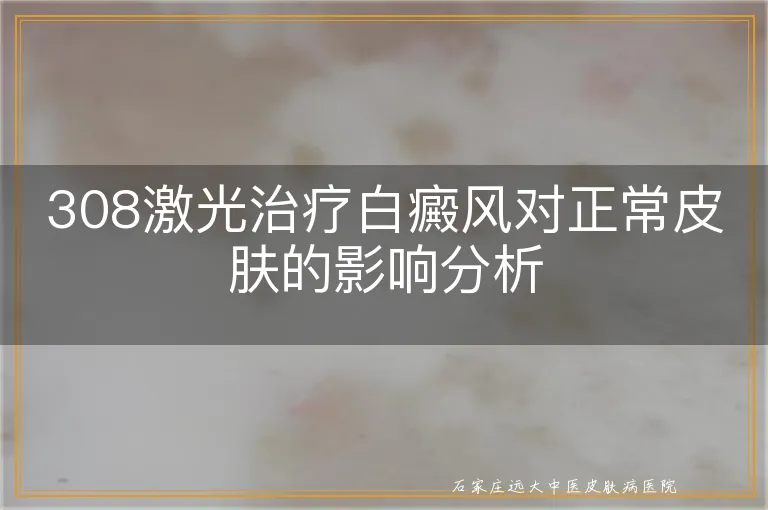 308激光治疗白癜风对正常皮肤的影响分析