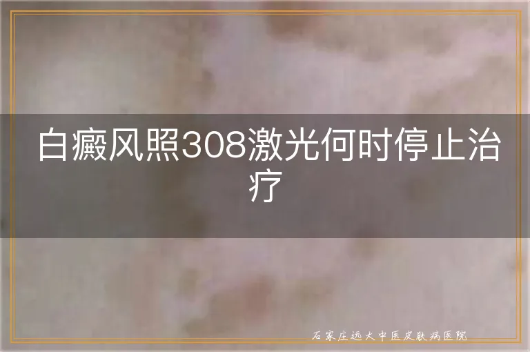 白癜风照308激光何时停止治疗