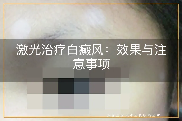 激光治疗白癜风：效果与注意事项