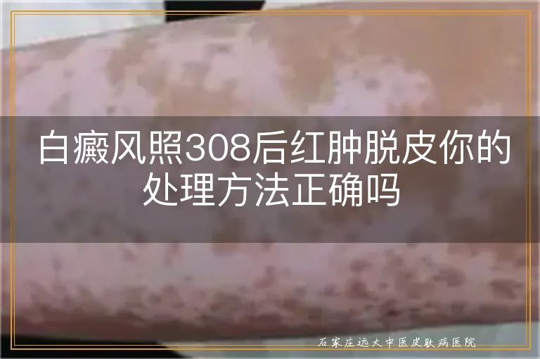 白癜风照308后红肿脱皮你的处理方法正确吗