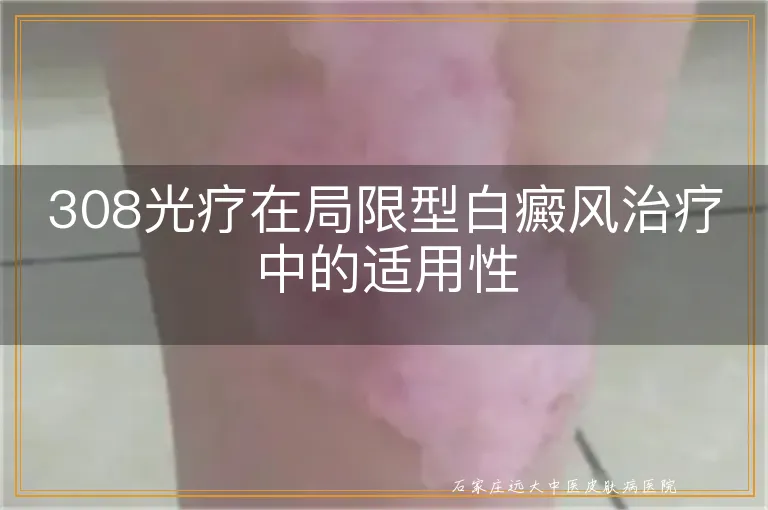 308光疗在局限型白癜风治疗中的适用性