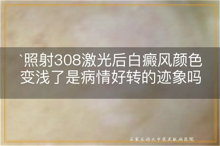 照射308激光后白癜风颜色变浅了是病情好转的迹象吗？