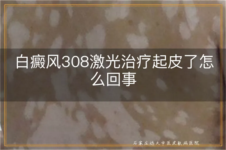 白癜风308激光治疗起皮了怎么回事