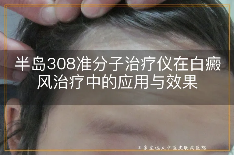 半岛308准分子治疗仪在白癜风治疗中的应用与效果