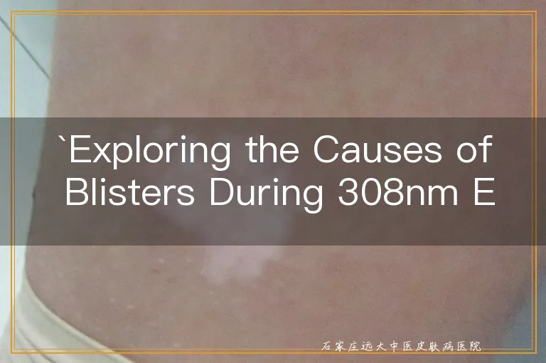 Exploring the Causes of Blisters During 308nm Excimer Laser Therapy for Vitiligo