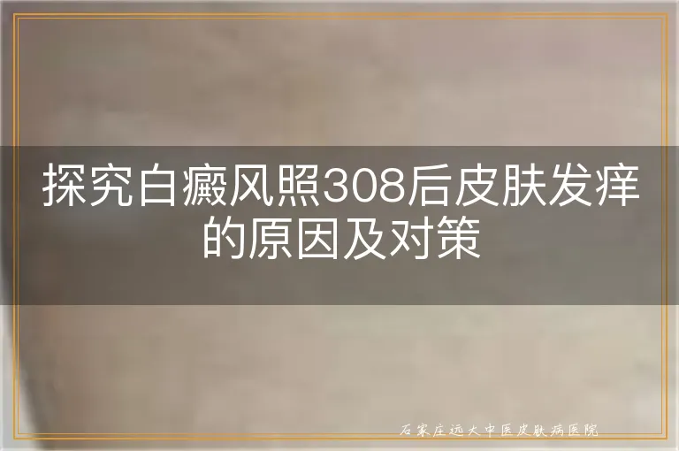 探究白癜风照308后皮肤发痒的原因及对策