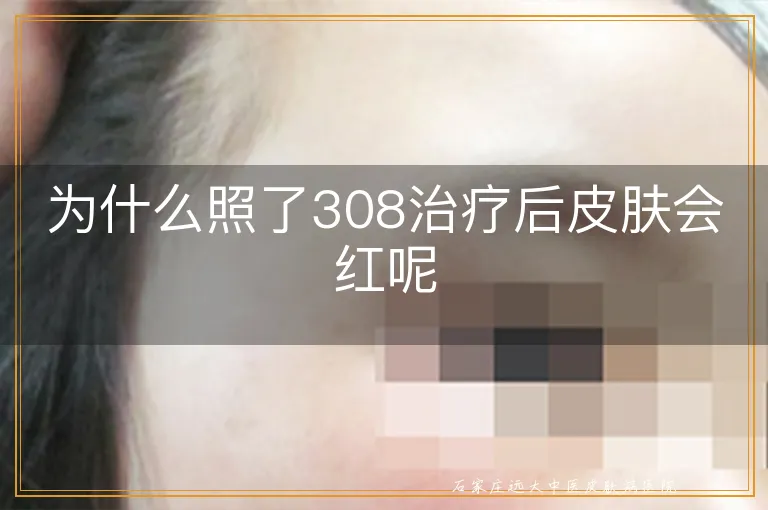 为什么照了308治疗后皮肤会红呢