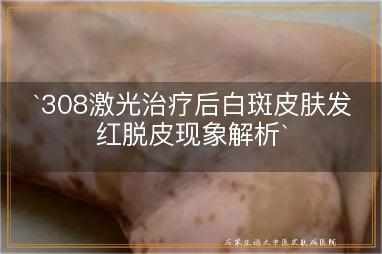 308激光治疗后白斑皮肤发红脱皮现象解析