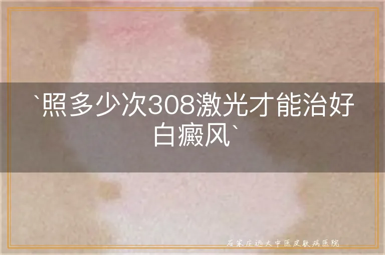 照多少次308激光才能治好白癜风