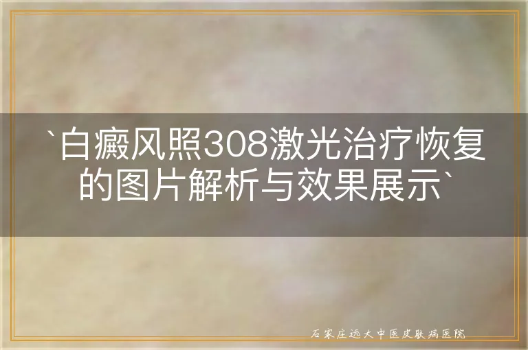 白癜风照308激光治疗恢复的图片解析与效果展示