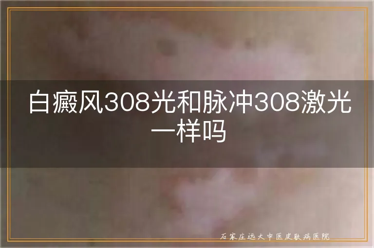 白癜风308光和脉冲308激光一样吗