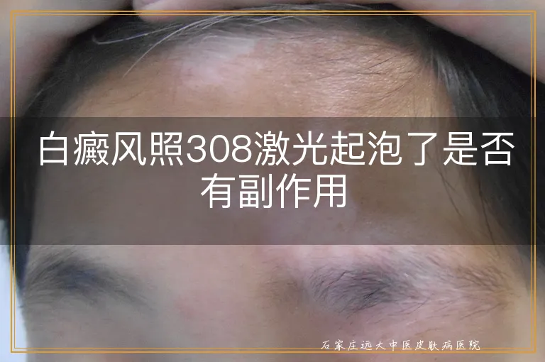 白癜风照308激光起泡了是否有副作用