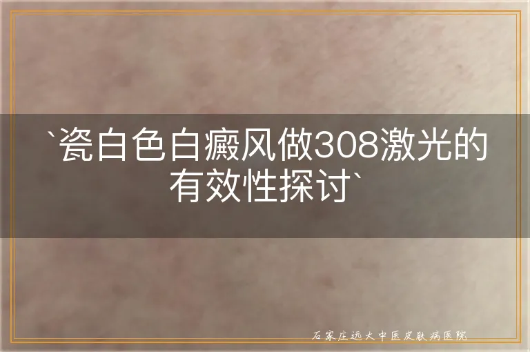 瓷白色白癜风做308激光的有效性探讨