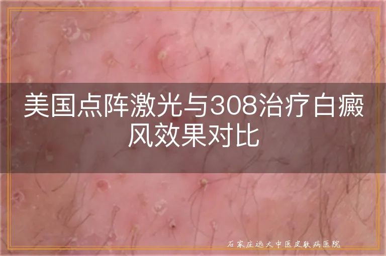 美国点阵激光与308治疗白癜风效果对比