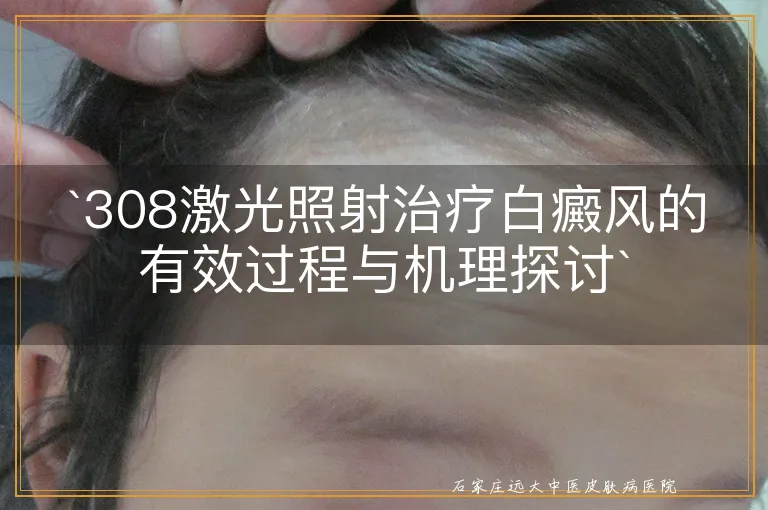 308激光照射治疗白癜风的有效过程与机理探讨