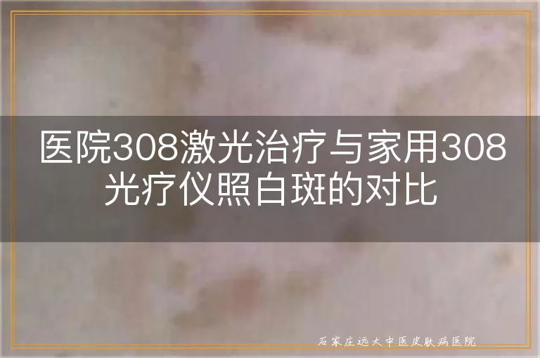 医院308激光治疗与家用308光疗仪照白斑的对比