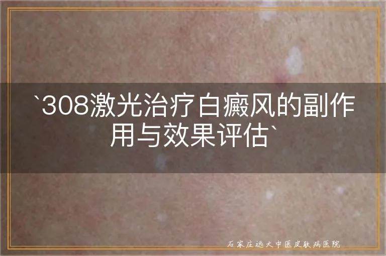 308激光治疗白癜风的副作用与效果评估