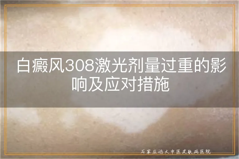 白癜风308激光剂量过重的影响及应对措施