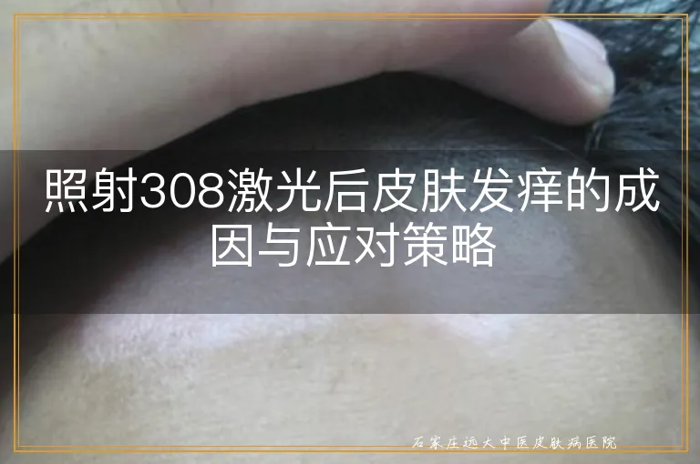 照射308激光后皮肤发痒的成因与应对策略