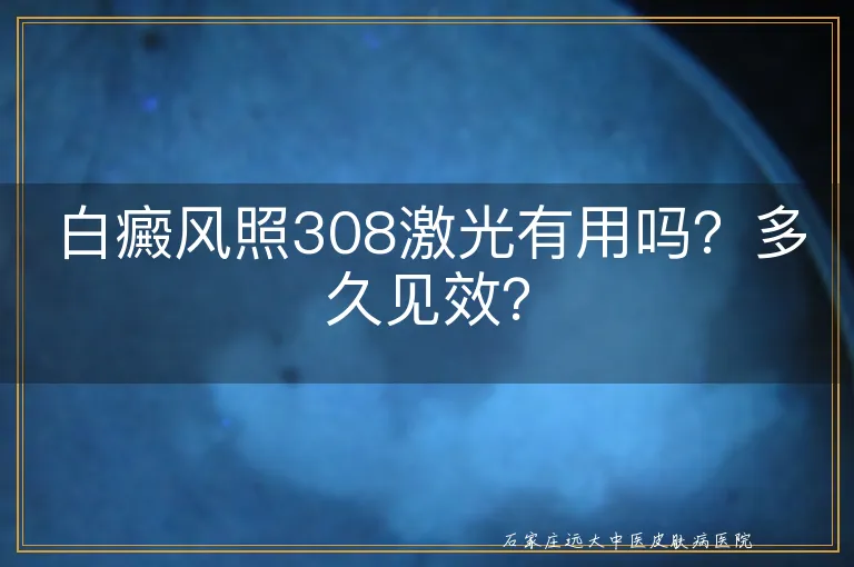 白癜风照308激光有用吗？多久见效？