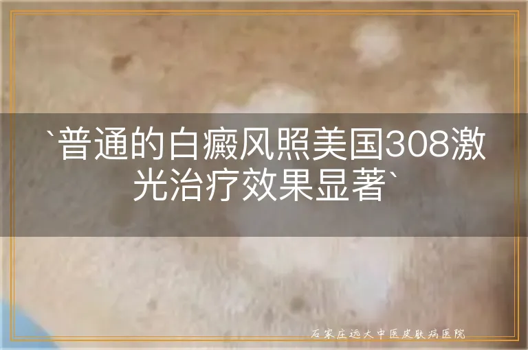 普通的白癜风照美国308激光治疗效果显著