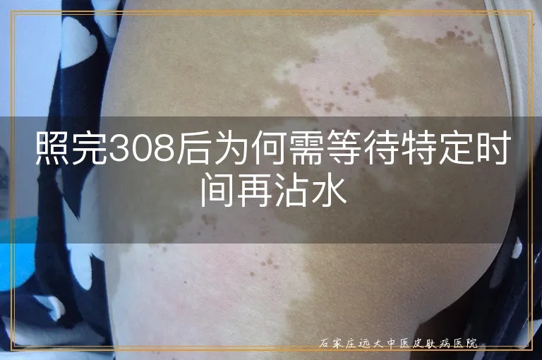 照完308后为何需等待特定时间再沾水