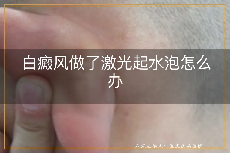 白癜风做了激光起水泡怎么办