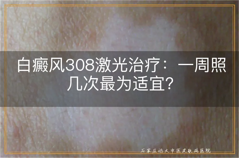 白癜风308激光治疗：一周照几次最为适宜？