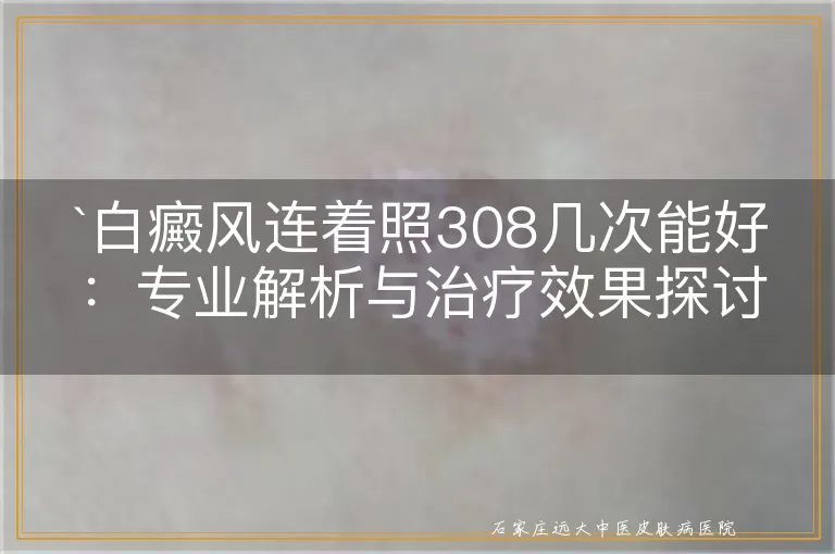 白癜风连着照308几次能好：专业解析与治疗效果探讨