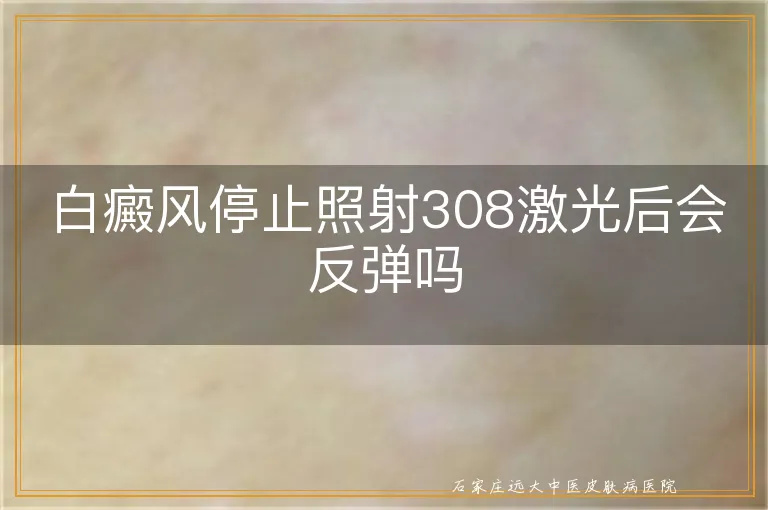 白癜风停止照射308激光后会反弹吗