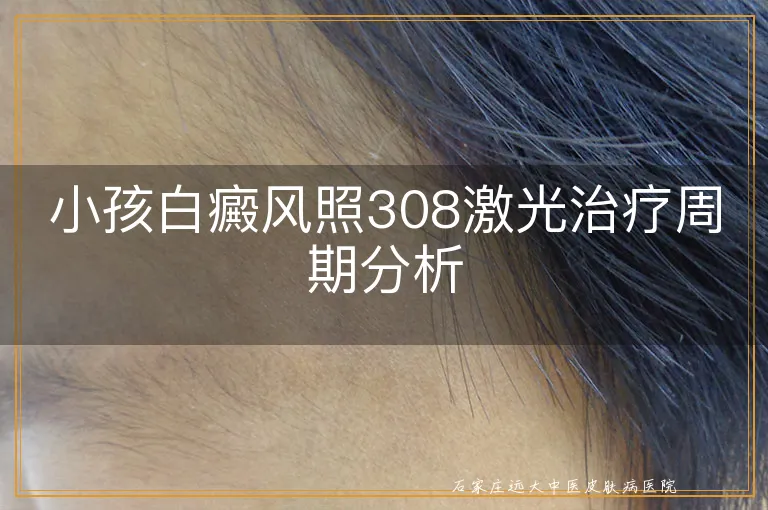 小孩白癜风照308激光治疗周期分析