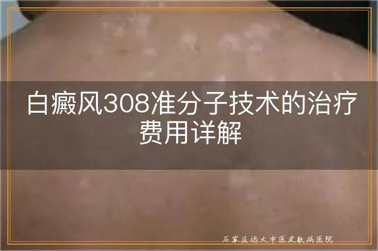 白癜风308准分子技术的治疗费用详解