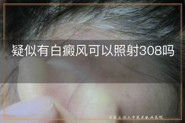 疑似有白癜风可以照射308吗