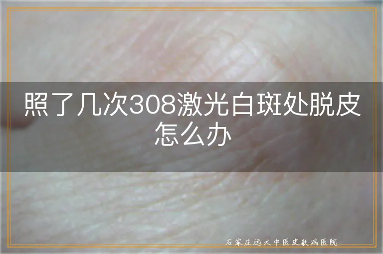 照了几次308激光白斑处脱皮怎么办