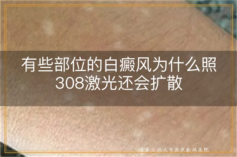 有些部位的白癜风为什么照308激光还会扩散