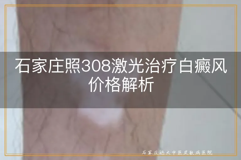 石家庄照308激光治疗白癜风价格解析