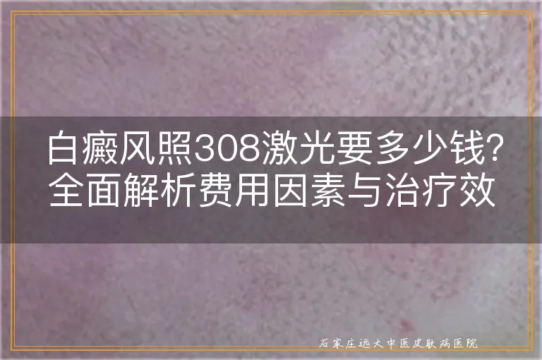 白癜风照308激光要多少钱？全面解析费用因素与治疗效果