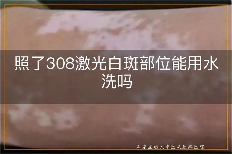 照了308激光白斑部位能用水洗吗