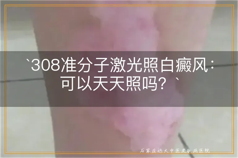 308准分子激光照白癜风：可以天天照吗？