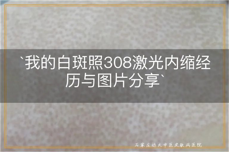 我的白斑照308激光内缩经历与图片分享