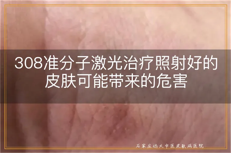 308准分子激光治疗照射好的皮肤可能带来的危害