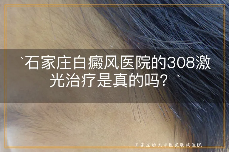 石家庄白癜风医院的308激光治疗是真的吗？