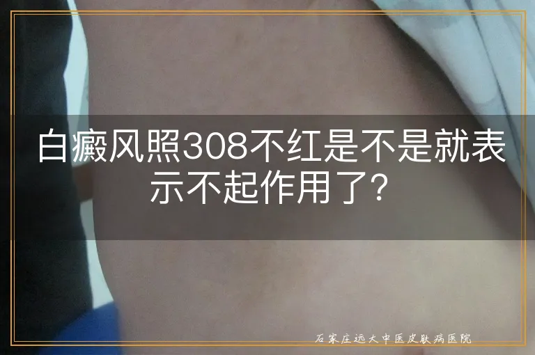 白癜风照308不红是不是就表示不起作用了？