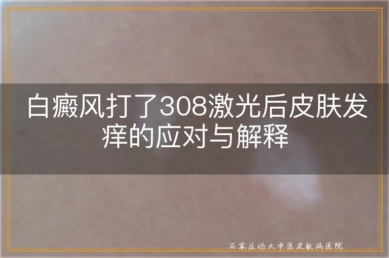 白癜风打了308激光后皮肤发痒的应对与解释