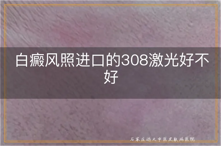 白癜风照进口的308激光好不好