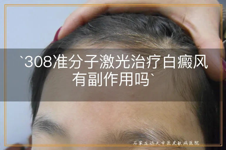 308准分子激光治疗白癜风有副作用吗